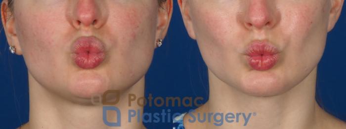 Before & After Chin Augmentation Case 293 Front - Puckering View in Washington DC & Arlington , DC