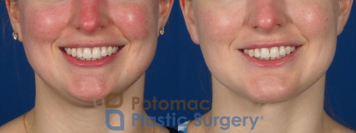 Before & After Chin Augmentation Case 293 Front - Smiling View in Washington DC & Arlington , DC