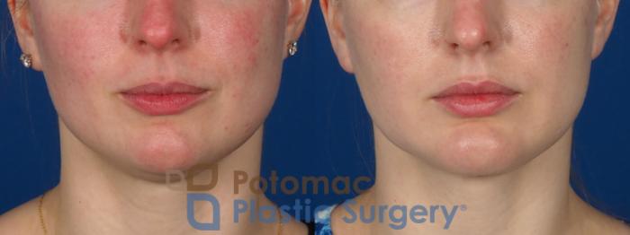 Before & After Chin Augmentation Case 293 Front View in Washington DC & Arlington , DC