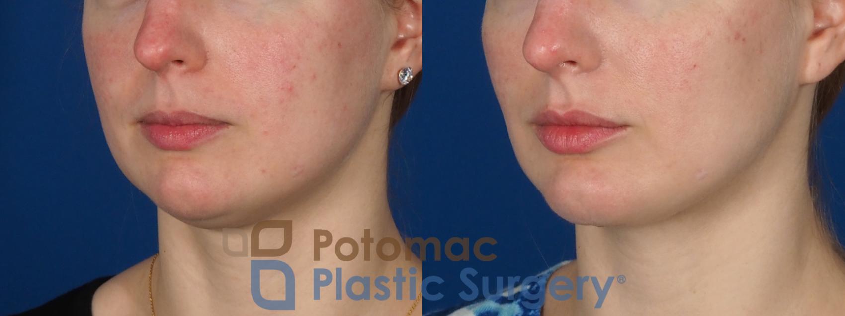Before & After Facial Sculpting Case 293 Left Oblique View in Washington DC & Arlington , DC