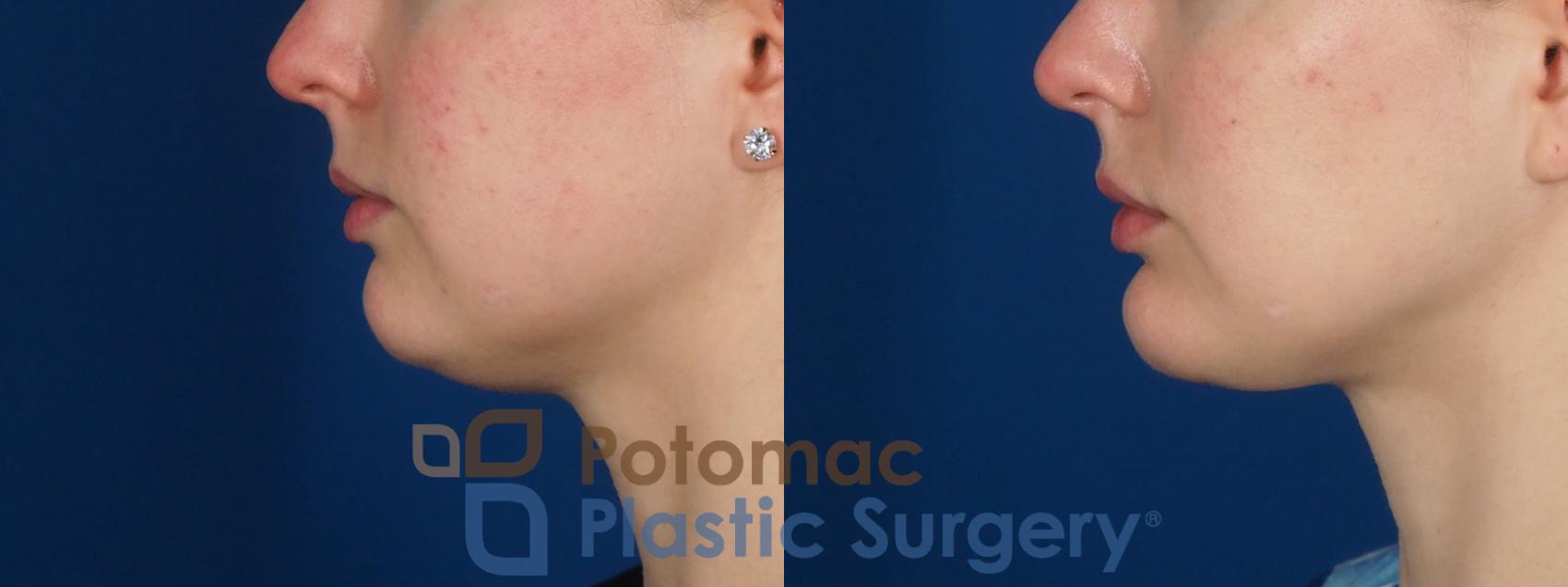 Before & After Facial Sculpting Case 293 Left Side View in Washington DC & Arlington , DC