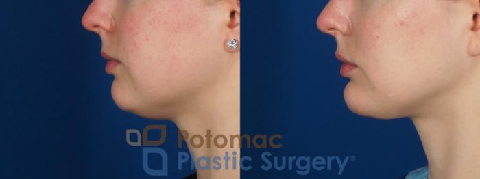 Before & After Facial Sculpting Case 293 Left Side View in Washington DC & Arlington , DC