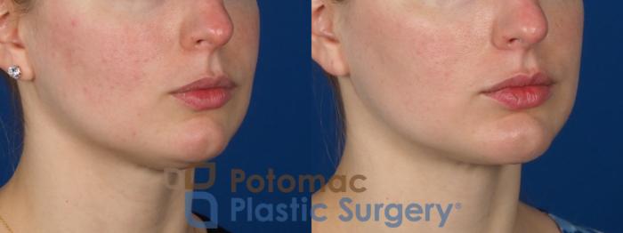 Before & After Liposuction Case 293 Right Oblique View in Washington DC & Arlington , DC