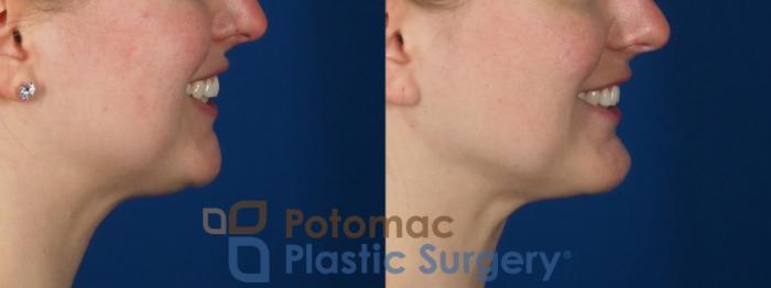 Before & After Facial Sculpting Case 293 Right Side - Smiling View in Washington DC & Arlington , DC