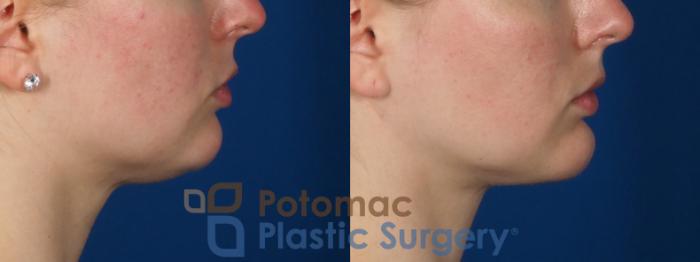 Before & After Liposuction Case 293 Right Side View in Washington DC & Arlington , DC