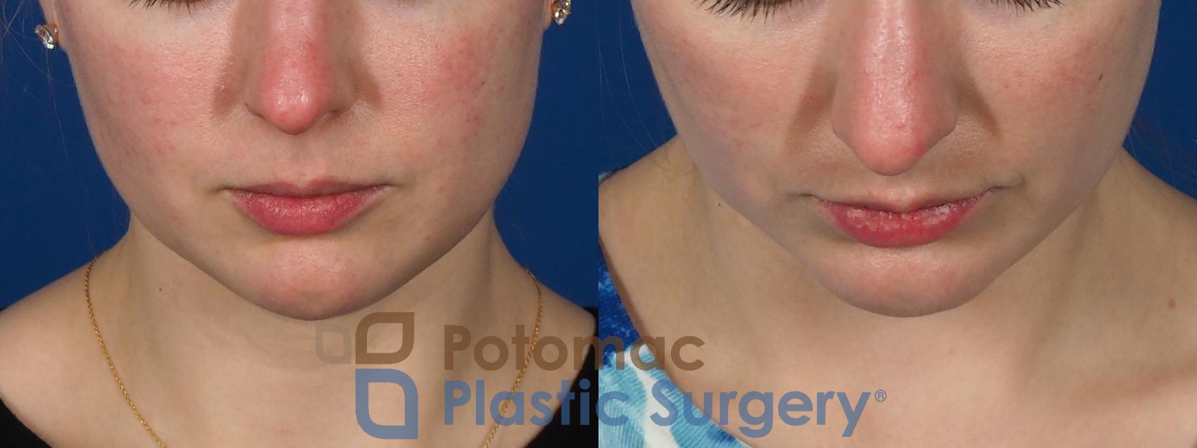 Before & After Facial Sculpting Case 293 Top View in Washington DC & Arlington , DC