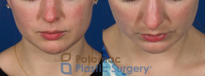 Before & After Liposuction Case 293 Top View in Washington DC & Arlington , DC