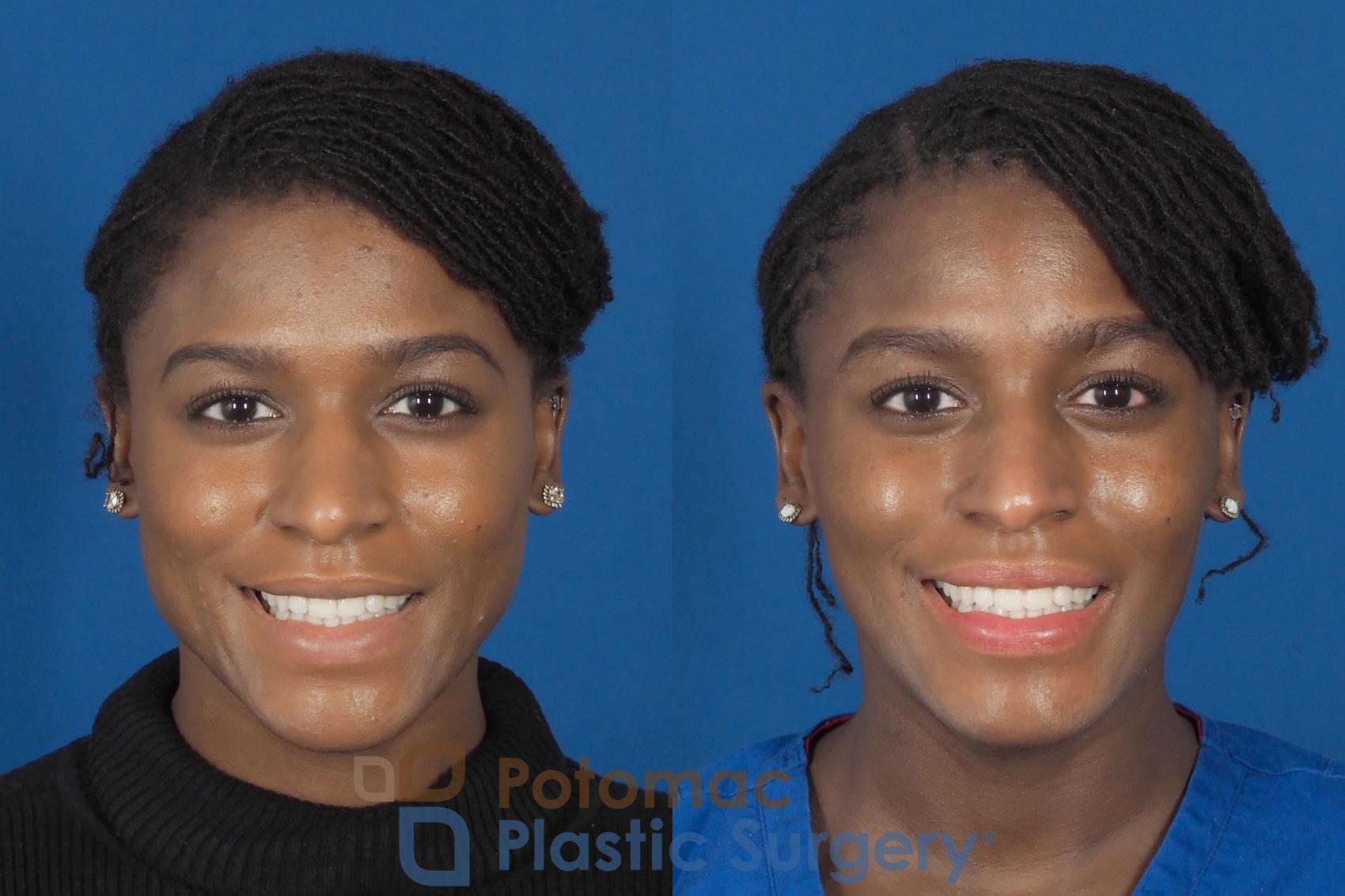 Facial sculpting to slim face with Botox for young woman