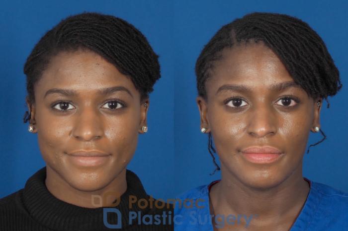 Before & After Facial Sculpting Case 300 Front View in Washington, DC