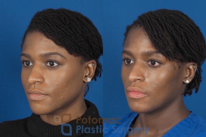 Before & After Facial Sculpting Case 300 Left Oblique View in Washington, DC