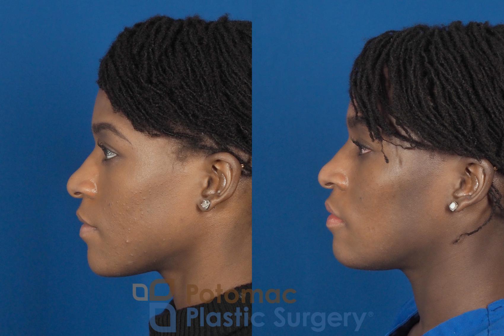 Before & After Facial Sculpting Case 300 Left Side View in Washington DC & Arlington , DC