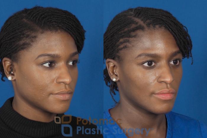 Before & After Facial Sculpting Case 300 Right Oblique View in Washington, DC