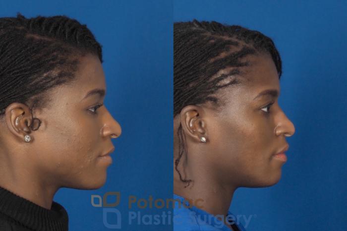 Before & After Facial Sculpting Case 300 Right Side View in Washington, DC