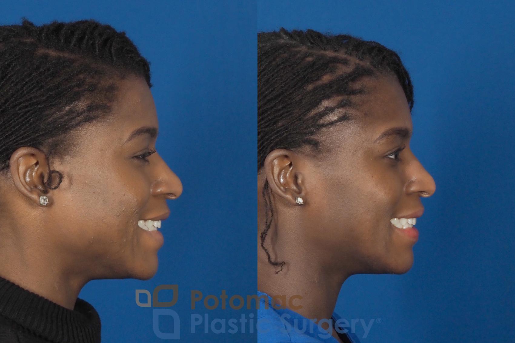 Before & After Facial Sculpting Case 300 Right - Smiling View in Washington DC & Arlington , DC