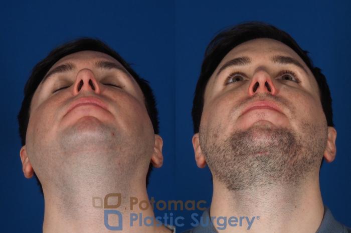 Before & After Chin Augmentation Case 315 Bottom View in Washington DC & Arlington , DC