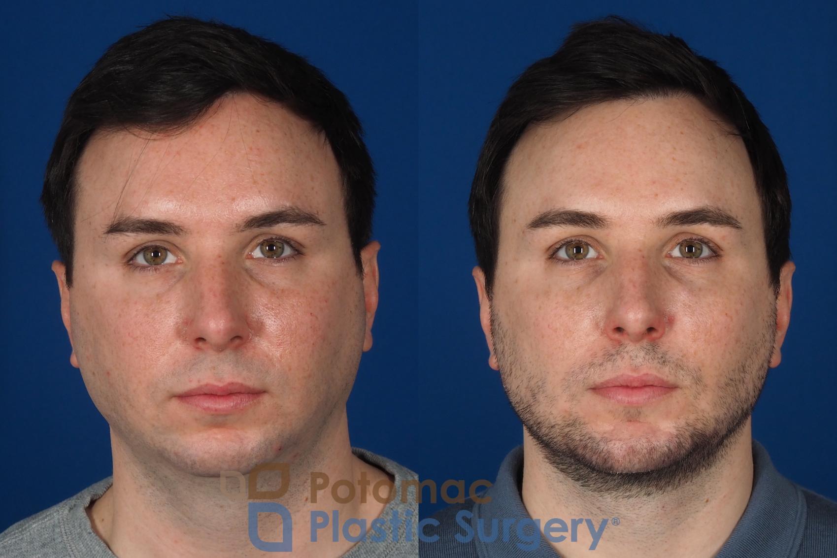 Before & After Facial Sculpting Case 315 Front View in Washington, DC