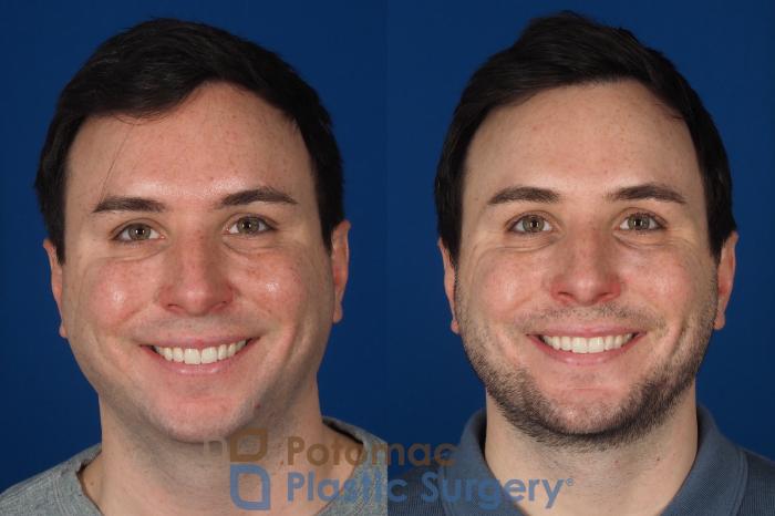 Before & After Buccal Fat Reduction Case 315 Front - Smiling View in Washington DC & Arlington , DC