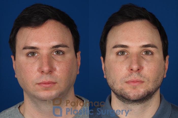 Before & After Buccal Fat Reduction Case 315 Front View in Washington DC & Arlington , DC