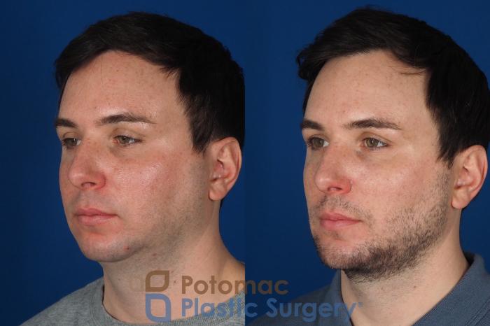 Before & After Chin Augmentation Case 315 Left Oblique View in Washington DC & Arlington , DC