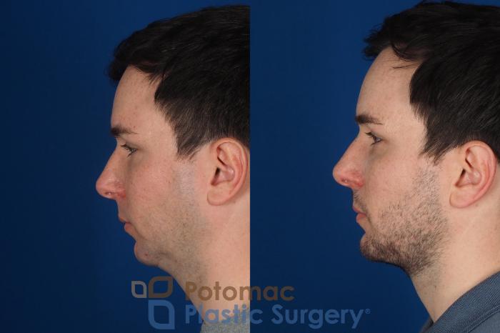 Before & After Chin Augmentation Case 315 Left Side View in Washington DC & Arlington , DC