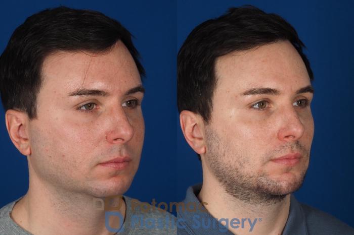 Before & After Liposuction Case 315 Right Oblique View in Washington DC & Arlington , DC