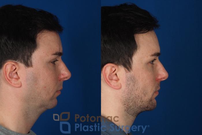 Before & After Buccal Fat Reduction Case 315 Right Side View in Washington DC & Arlington , DC