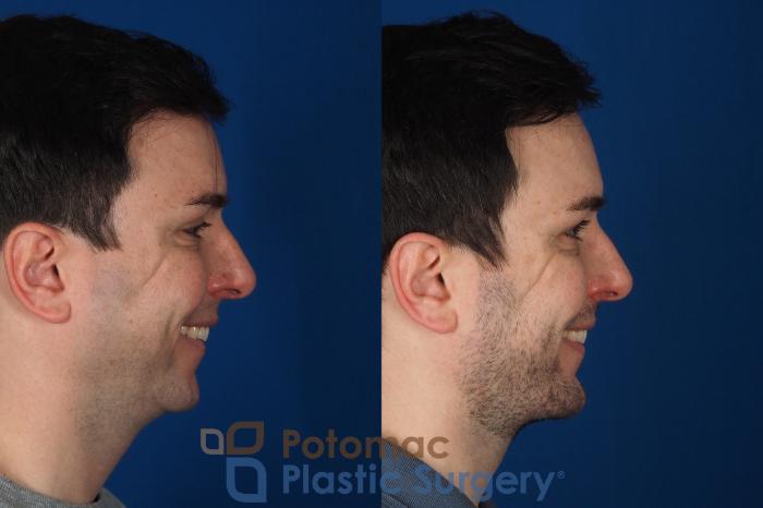 Before & After Liposuction Case 315 Right - Smiling View in Washington DC & Arlington , DC