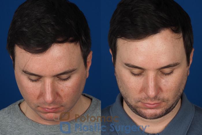 Before & After Chin Augmentation Case 315 Top View in Washington DC & Arlington , DC