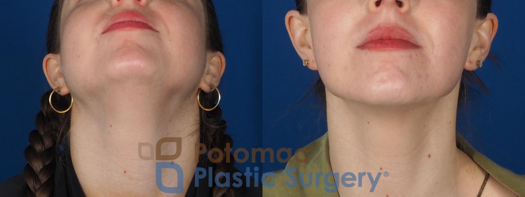 Before & After Botox Cosmetic Case 317 Bottom View in Washington DC & Arlington , DC