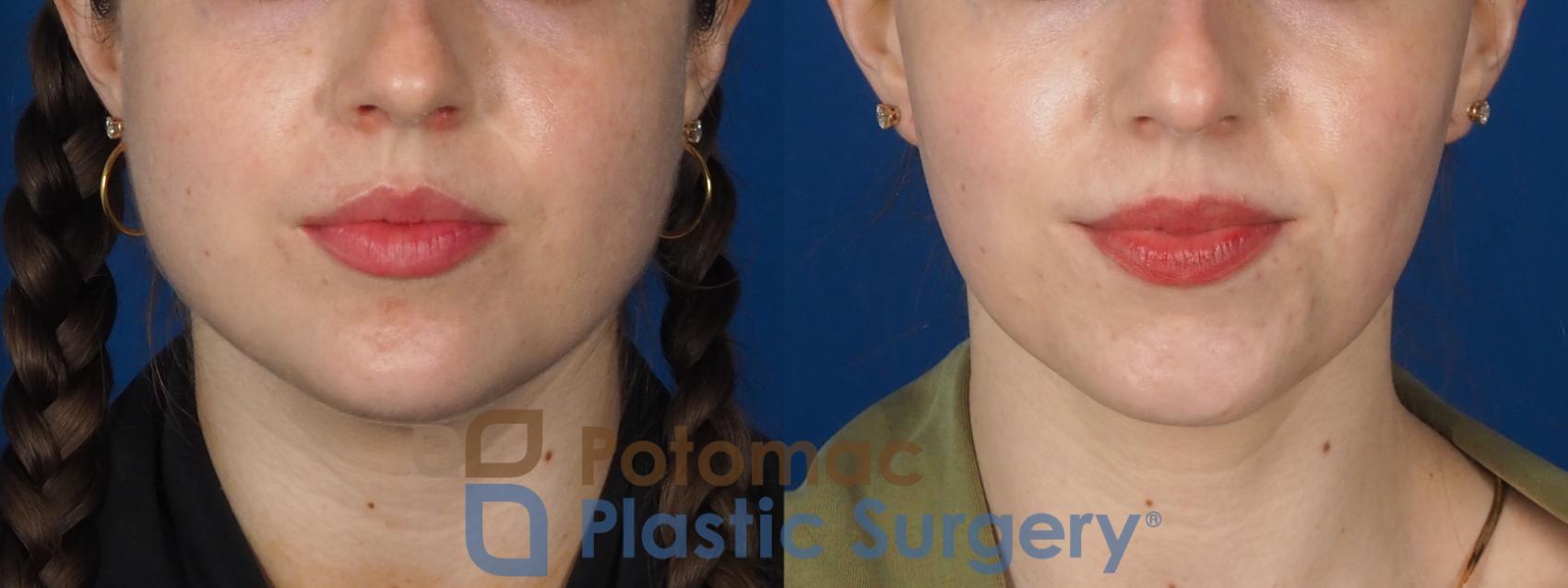 Before & After Facial Sculpting Case 317 Front View in Washington, DC