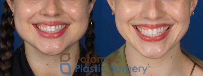 Before & After Facial Sculpting Case 317 Front - Smiling View in Washington, DC