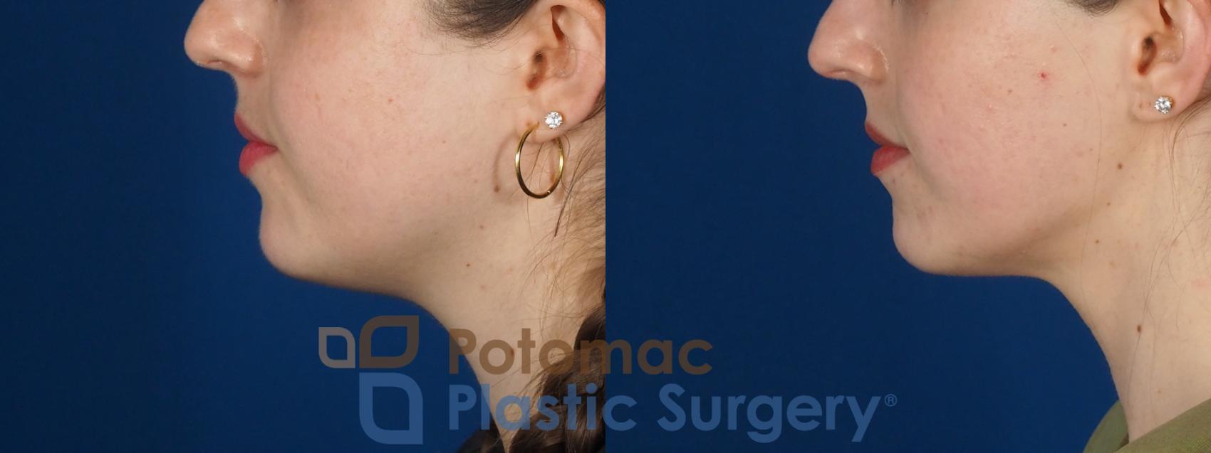 Before & After Botox Cosmetic Case 317 Left Side View in Washington DC & Arlington , DC