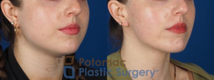 Before & After Facial Sculpting Case 317 Right Oblique View in Washington, DC
