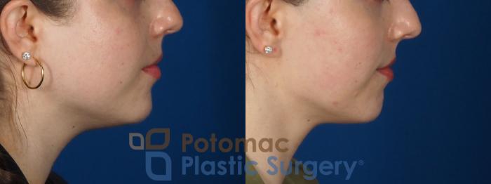 Before & After Facial Sculpting Case 317 Right Side View in Washington, DC