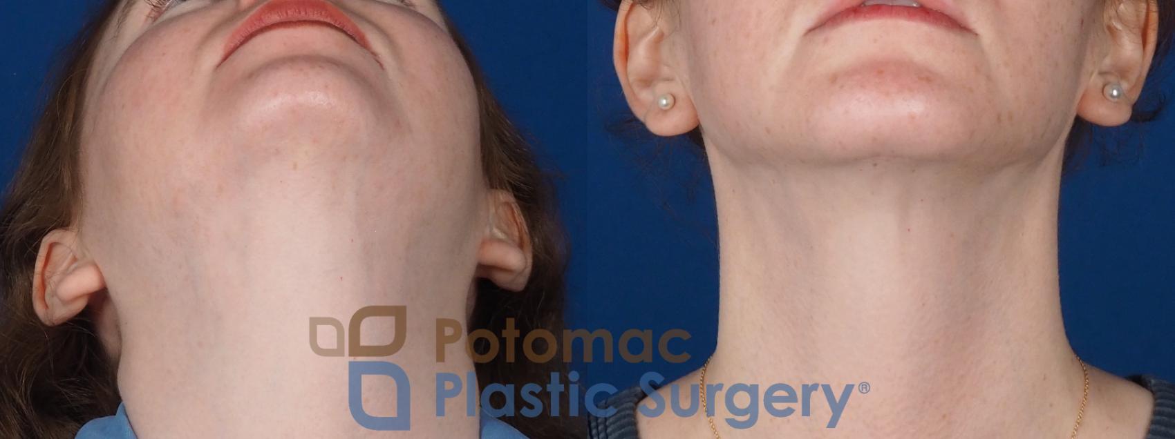Before & After Facial Sculpting Case 320 Bottom View in Washington DC & Arlington , DC