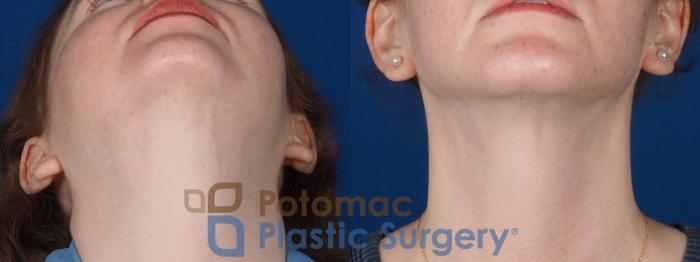 Before & After Chin Augmentation Case 320 Bottom View in Washington DC & Arlington , DC