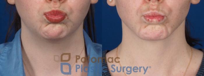 Before & After Chin Augmentation Case 320 Front - Puckering View in Washington DC & Arlington , DC