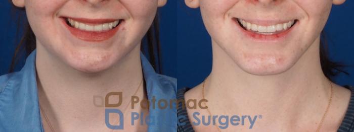 Before & After Liposuction Case 320 Front - Smiling View in Washington DC & Arlington , DC