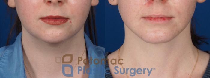 Before & After Liposuction Case 320 Front View in Washington DC & Arlington , DC