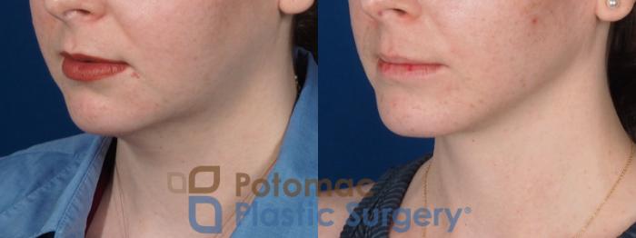 Before & After Liposuction Case 320 Left Oblique View in Washington DC & Arlington , DC