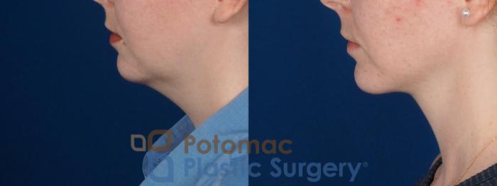 Before & After Liposuction Case 320 Left Side View in Washington DC & Arlington , DC