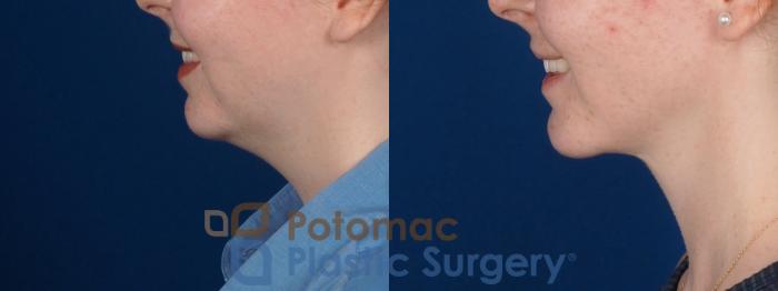 Before & After Chin Augmentation Case 320 Left - Smiling View in Washington DC & Arlington , DC