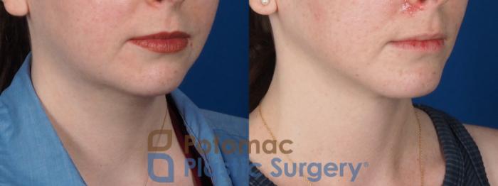 Before & After Chin Augmentation Case 320 Right Oblique View in Washington DC & Arlington , DC
