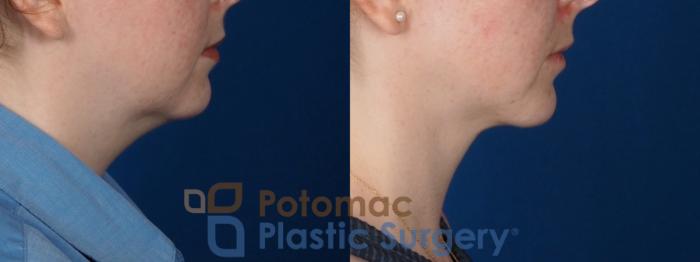 Before & After Chin Augmentation Case 320 Right Side View in Washington DC & Arlington , DC