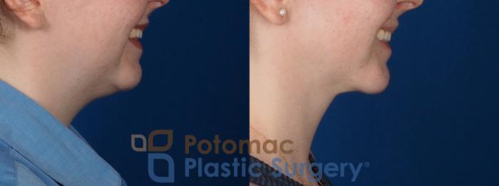 Before & After Liposuction Case 320 Right - Smiling View in Washington DC & Arlington , DC