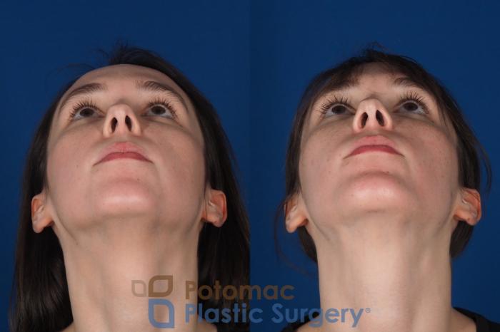 Before & After Chin Augmentation Case 344 Bottom View in Washington DC & Arlington , DC