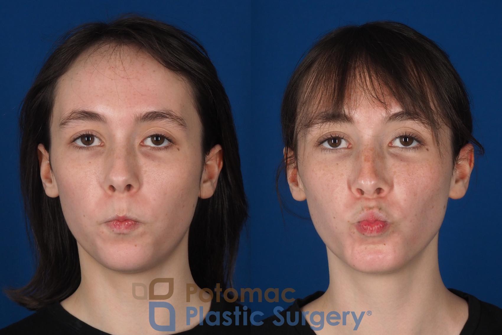 Before & After Facial Sculpting Case 344 Front - Puckering View in Washington DC & Arlington , DC