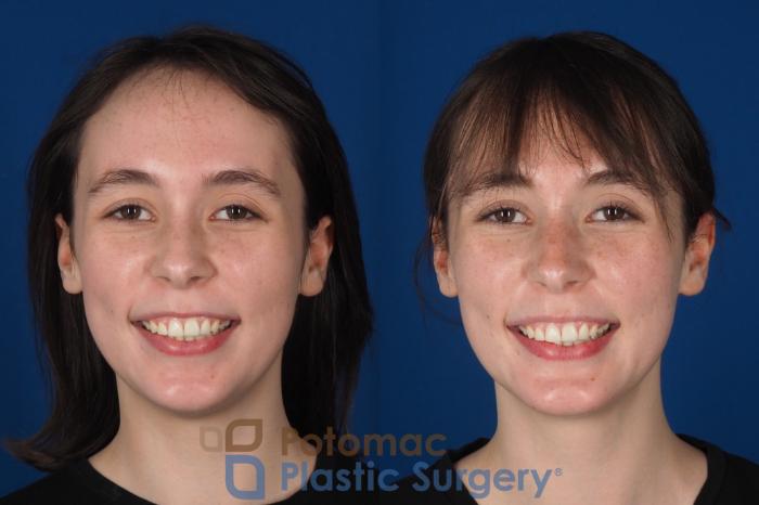 Before & After Chin Augmentation Case 344 Front - Smiling View in Washington DC & Arlington , DC
