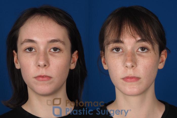 Before & After Chin Augmentation Case 344 Front View in Washington DC & Arlington , DC