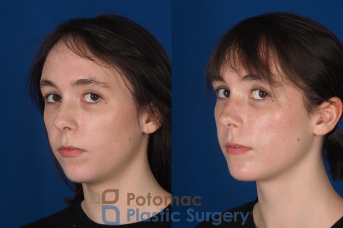 Before & After Chin Augmentation Case 344 Left Oblique 2 View in Washington DC & Arlington , DC